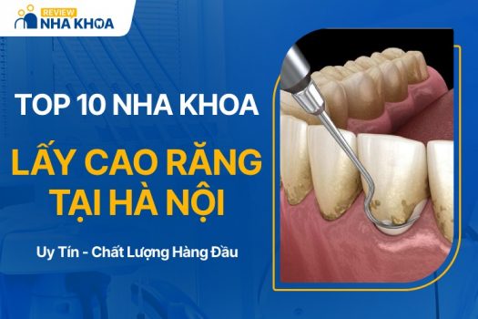 Địa chỉ nha khoa lấy cao răng ở hà nội