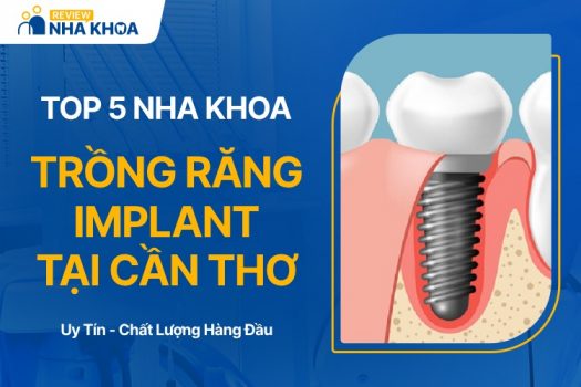 Địa chỉ trồng răng implant tại cần thơ