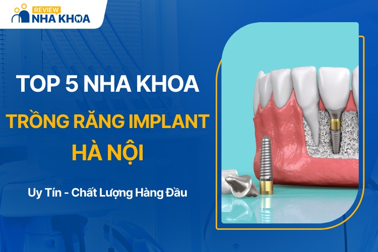 Địa chỉ nha khoa trồng răng implant Hà Nội