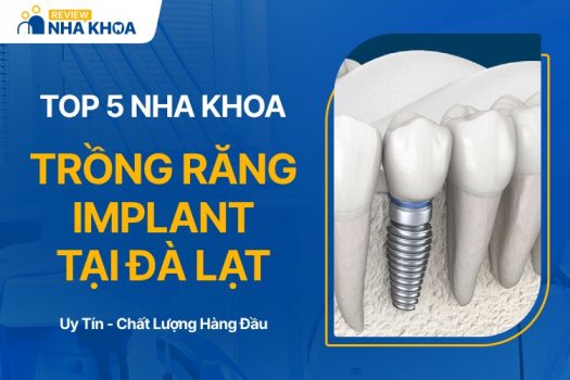 địa chỉ nha khoa trồng răng implant tại đà lạt