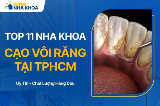 TOP 10 Địa Chỉ Cạo Vôi Răng Giá Tốt Và Uy Tín Nhất TPHCM