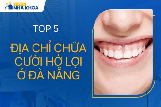 5 Địa Chỉ Chữa Cười Hở Lợi Ở Đà Nẵng Uy Tín, Được Review Tốt