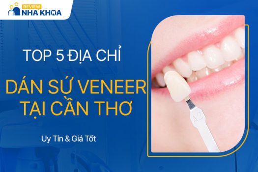 Top 5 Địa Chỉ Dán Sứ Veneer Uy Tín, Giá Tốt Tại Cần Thơ