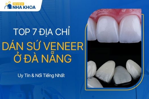 Review 7 Địa Chỉ Dán Sứ Veneer Uy Tín, Nổi Tiếng Ở Đà Nẵng