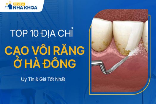 Địa Chỉ Lấy Cao Răng Hà Đông