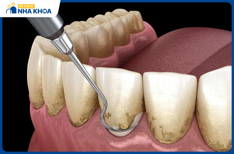 Cạo vôi răng tại nha khoa Dr Smile giúp loại bỏ sạch các mảng bám mà không gây đau nhức, ê buốt