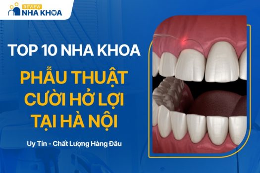 Địa chỉ phẫu thuật cười hở lợi tại Hà Nội