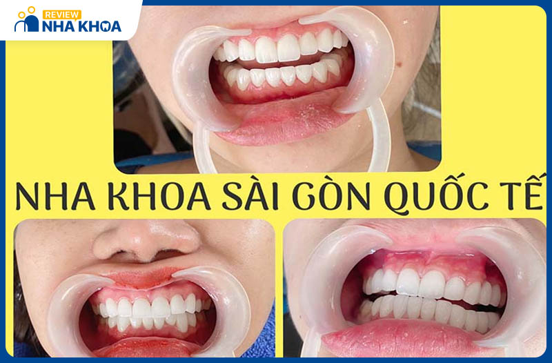 Nha khoa Sài Gòn Quốc tế mang đến cho khách hàng hàm răng khỏe đẹp