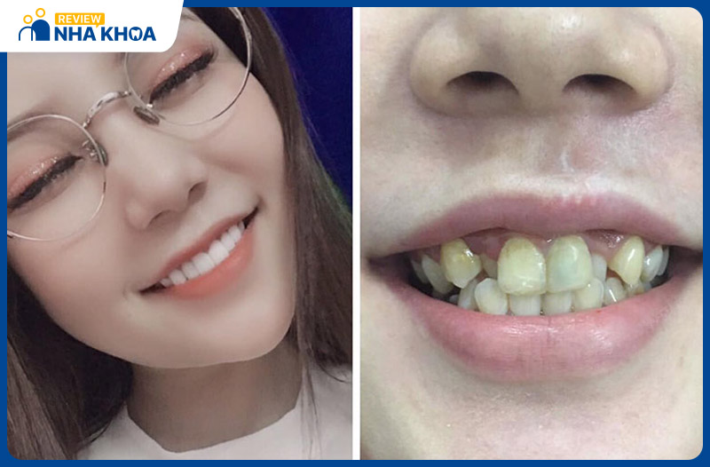 Nha khoa Thẩm mỹ Quốc tế City Dental có đội ngũ bác sĩ giỏi, chỉnh nha thành công cho nhiều trường hợp nặng