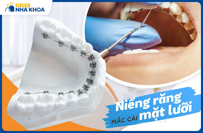 Chỉnh nha tại Nha khoa Up Dental với đội ngũ bác sĩ lành nghề và công nghệ tiên tiến