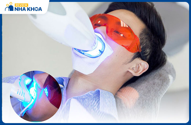 Tẩy trắng răng tại Nha khoa Sài Gòn Bình Dương bởi bác sĩ giỏi và công nghệ Laser Whitening