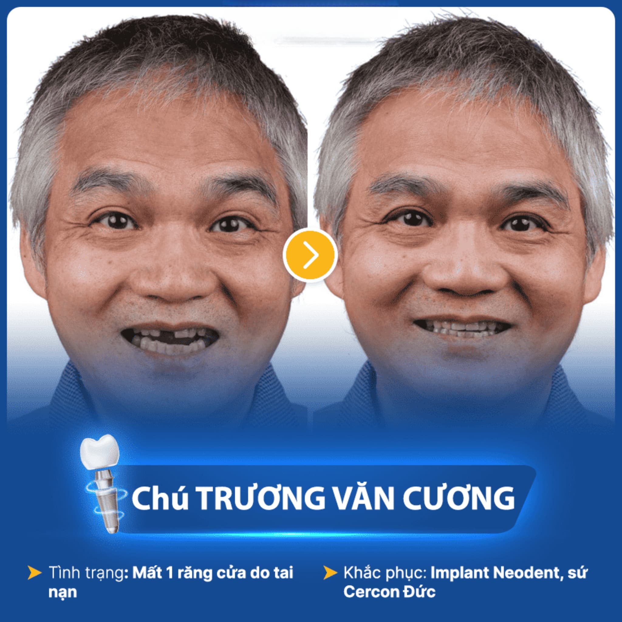 Chú Cương trước và sau khi trồng răng implant tại ViDental 