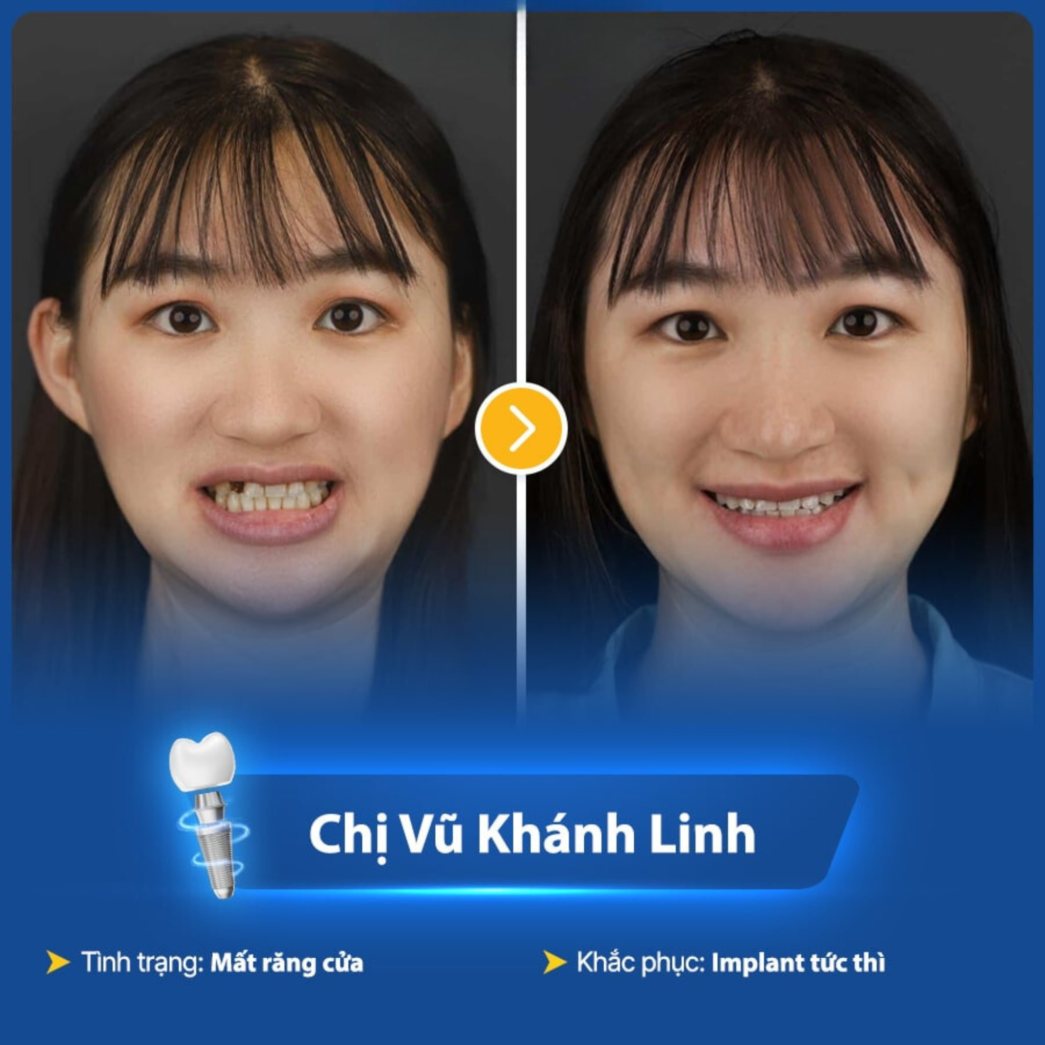 Chị Linh trước và sau khi trồng răng implant tại ViDental