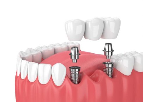 Trồng răng Implant: Trả góp lãi suất 0%