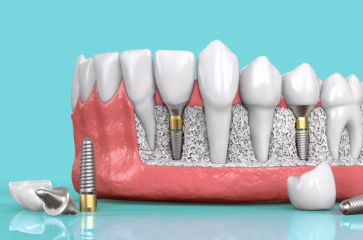 Trồng răng Implant: Chính sách trợ giá, trả góp 0%