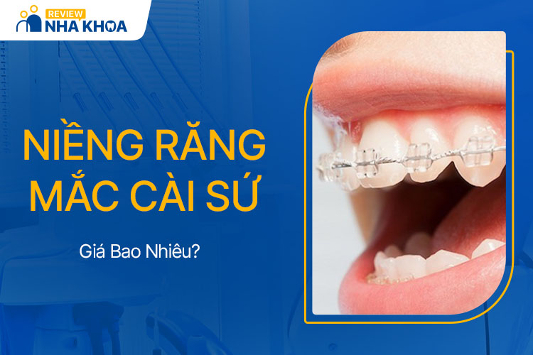 Niềng Răng Mắc Cài Sứ Giá Bao Nhiêu?