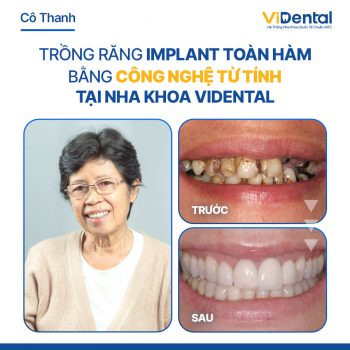 Trồng răng implant chỉ từ 4 triệu 999k/ trụ