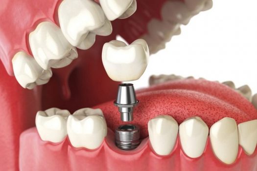 Giảm 50% tối đa 500.000Đ cho dịch vụ trồng răng Implant