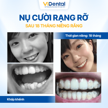 Niềng răng trả góp chỉ từ 1 triệu/ tháng 