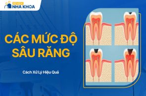 Các Mức Độ Sâu Răng Và Biện Pháp Phòng Ngừa Hiệu Quả Nhất