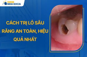 Tổng Hợp Những Cách Trị Lỗ Sâu Răng An Toàn, Hiệu Quả Nhất