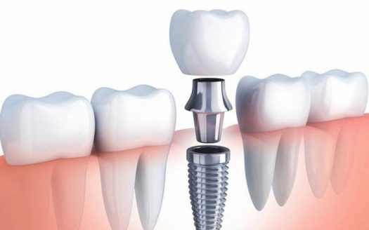 Giảm đến 20% khi trồng răng Implant