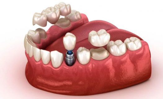 Giảm 30% phí trồng răng Implant