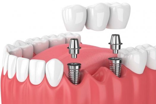 Trồng răng Implant GIẢM 4 TRIỆU