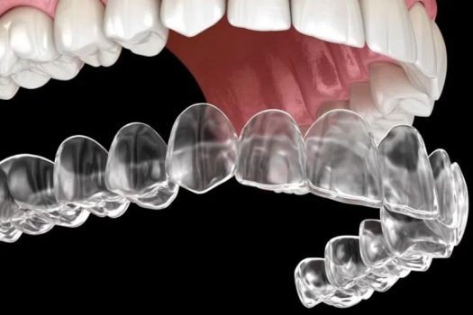 Niềng răng Invisalign GIẢM ĐẾN 20%