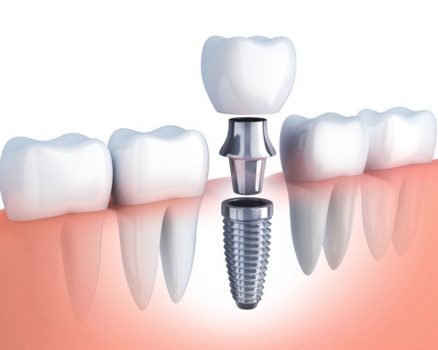 Trồng răng Implant ưu đãi 50%, giảm xuống chỉ còn 3.900.000đ/trụ.