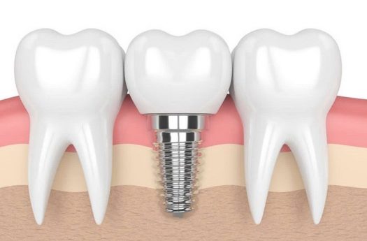 Giảm 13 triệu đồng/trụ trồng răng Implant Thụy Sĩ cao cấp