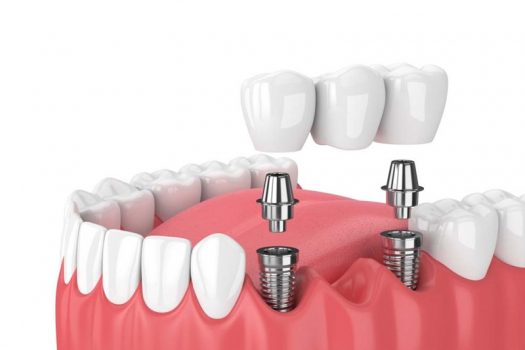 Trồng răng Implant GIẢM GIÁ ĐẾN 20%