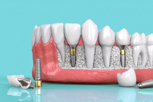 Trồng răng Implant GIẢM GIÁ ĐẾN 20%