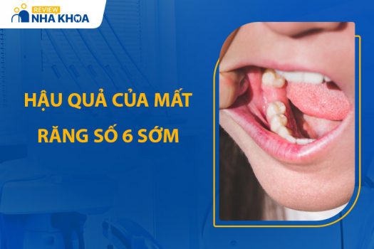 Hậu Quả Của Mất Răng Số 6 Sớm Và Hướng Dẫn Khắc Phục