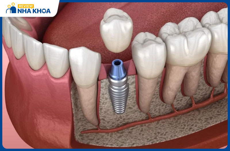 Cấy ghép Implant là phương pháp hiện đại, nhiều ưu điểm