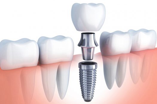 Tặng răng sứ Zirconia 5 triệu khi trồng răng Implant