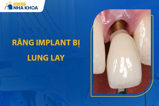 Răng Implant Bị Lung Lay: Nguyên Nhân Và Phương Pháp Xử Lý