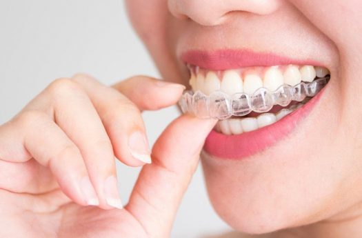 Giảm 30 triệu khi niềng răng Invisalign