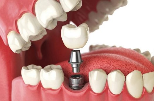 Tặng 2 triệu/trụ khi trồng răng Implant