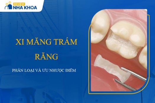 Xi Măng Trám Răng: Lựa Chọn Tốt Nhất Cho Răng Miệng Khỏe Mạnh